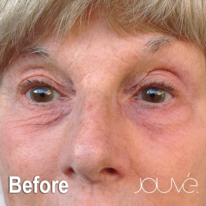 Jouve-Heshie-Before