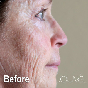 Jouve-Lynn-Before